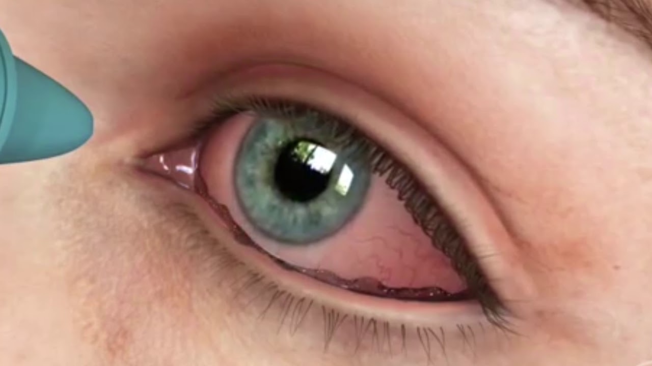 Todo lo que debes saber sobre el poral oftalmico: beneficios y usos 8 Todo lo que debes saber sobre el poral oftalmico: beneficios y usos